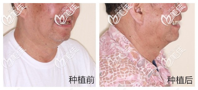 老爸做半口allon4種植牙前后對(duì)比照片