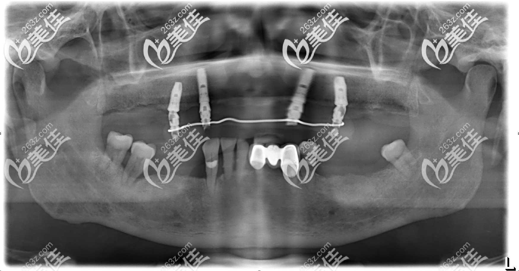 老爸在成都極光口腔種牙后的拍的片子