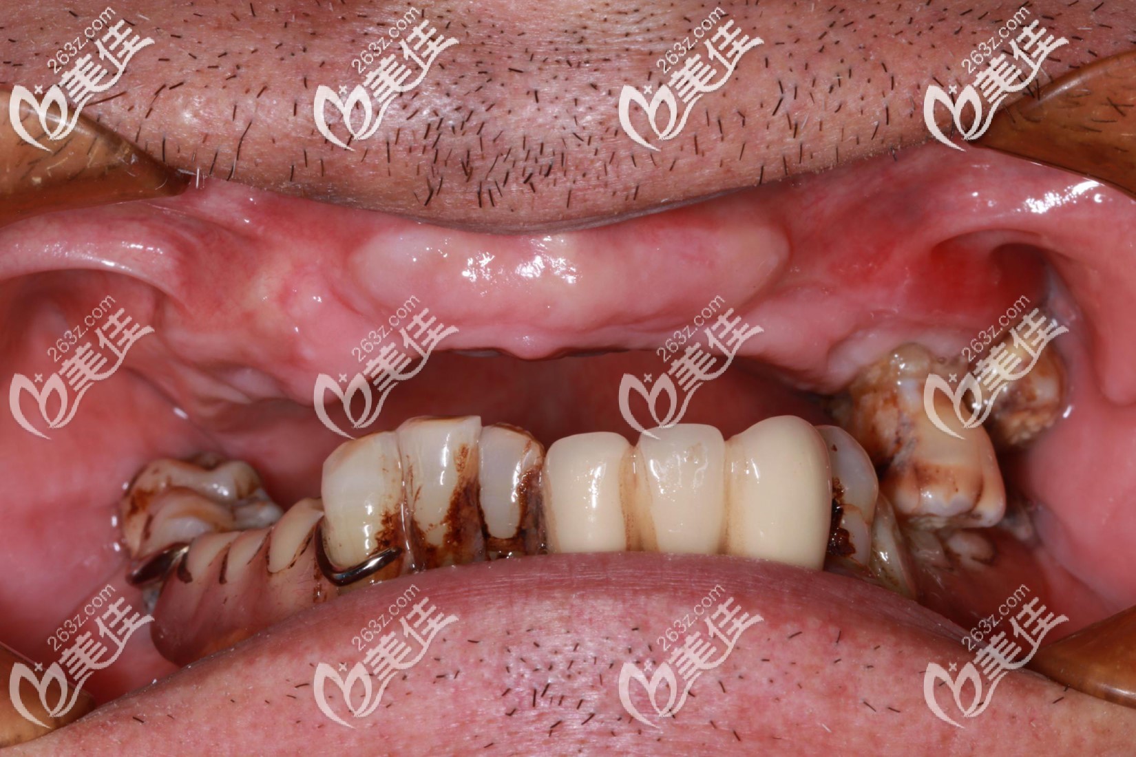 65歲老爸在成都錦江口腔連鎖做上半口allon4即刻種植牙選擇是瑞典諾貝爾植體而不是iti，和價(jià)格無關(guān)