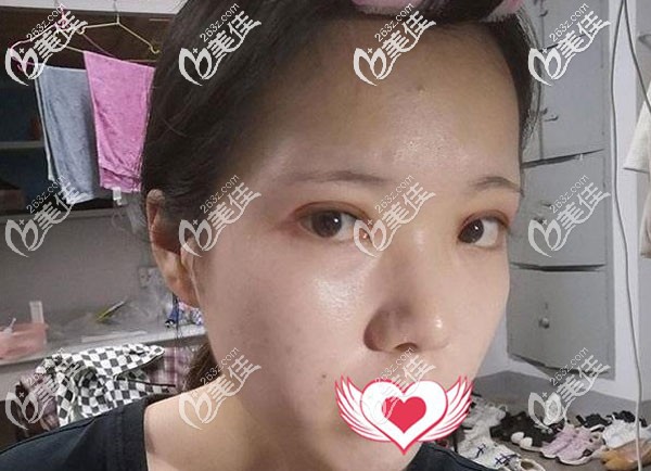 做雙眼皮第7天拆線后有點(diǎn)腫