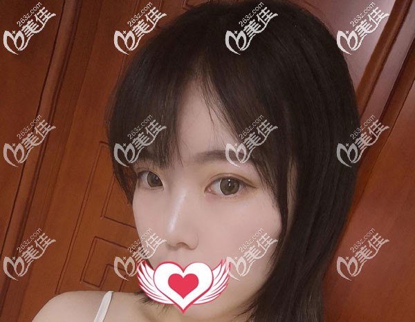 眼綜合一個(gè)月沒有出現(xiàn)疤痕增生