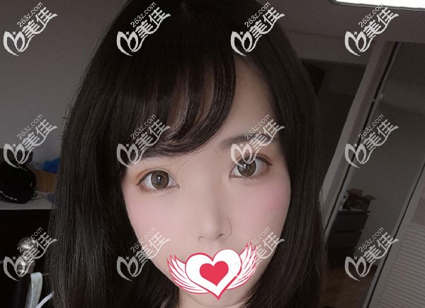 切開雙眼皮2個(gè)月恢復(fù)的很自然