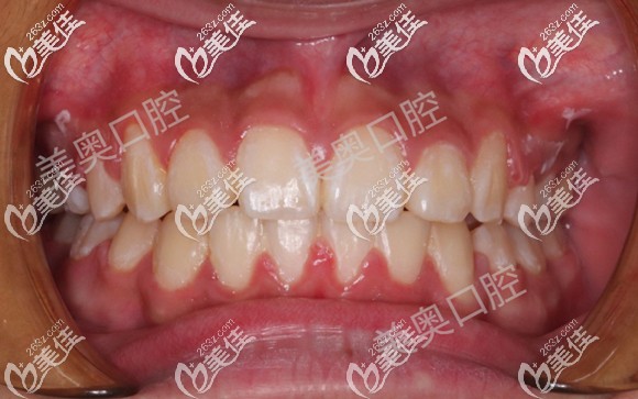 常州美奧口腔正畸新案例-14歲青少年安氏一類錯牙合的矯正效果