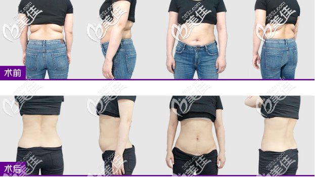 后背贅肉+腰腹部
