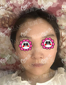 我做波紋式顴骨縮小有二十多天了