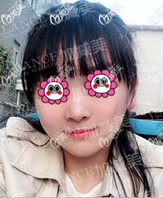 我找北京加減美黃寅守做波紋式顴骨縮小術案例效果和拿到的磨骨價格表分享