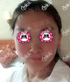 北京加減美黃寅守波紋式顴骨縮小案例