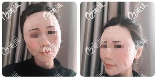 面部脂肪填充手術(shù)后當(dāng)天