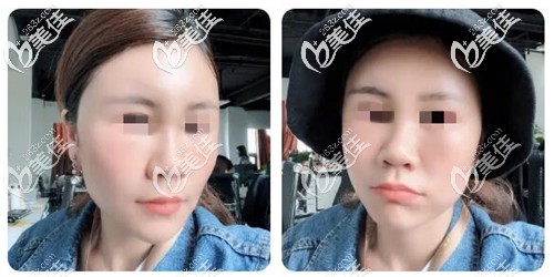 面部脂肪填充第三天恢復(fù)照片