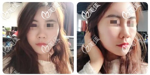 面部脂肪填充15天恢復(fù)照片