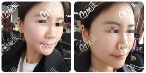 脂肪填充術(shù)后3個(gè)月的恢復(fù)效果