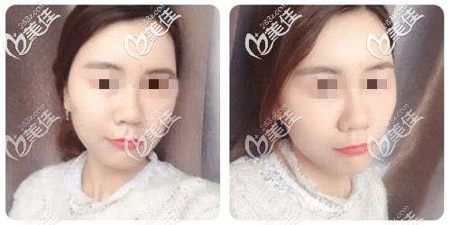 面部脂肪填充記錄過程中發(fā)現(xiàn)，雖然一個(gè)月內(nèi)很丑但一年后很自然也沒凹陷