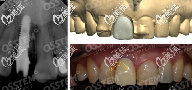 萬萬沒想到女朋友門牙是假的，她曾在成都極光口腔做了韓國(guó)奧齒泰即刻種植牙…