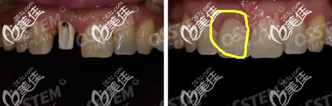 韓國奧齒泰種植牙前后效果圖 韓國奧齒泰種植牙前后效果圖