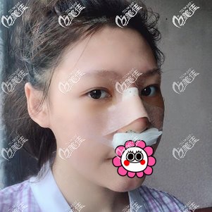 肋軟骨隆鼻術(shù)后恢復(fù)三天