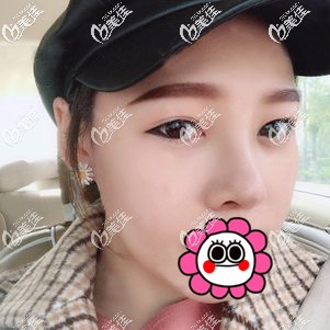 肋軟骨隆鼻恢復(fù)20天效果