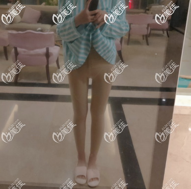 青島華顏美術(shù)前大腿吸脂術(shù)后第二天的時候