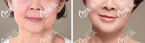 <!--<i data=20240703-sp></i>-->薛欣醫(yī)生除皺案例