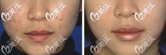 <!--<i data=20240703-sp></i>-->薛欣醫(yī)生激光祛痘案例