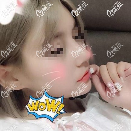 我找武漢匠星雷云飛做鼻綜合恢復(fù)三個(gè)月效果照片 我找武漢匠星雷云飛做鼻綜合恢復(fù)三個(gè)月效果照片