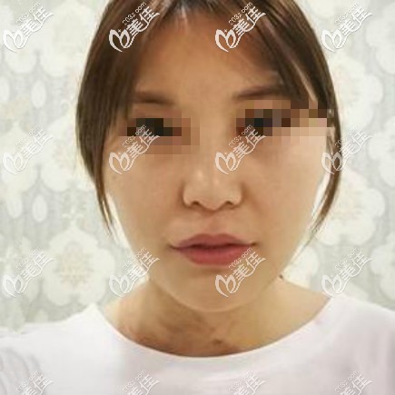 做肋骨鼻綜合術(shù)前照片 做肋骨鼻綜合術(shù)前照片