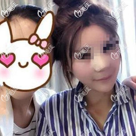 肋骨鼻綜合術(shù)后第1天 肋骨鼻綜合術(shù)后第1天