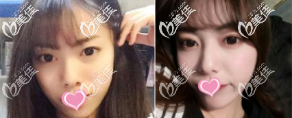 <!--<i data=20240703-sp></i>--><!--<i data=20240703-sp></i>-->庭切開雙眼皮案例