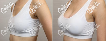 <!--<i data=20240703-sp></i>--><!--<i data=20240703-sp></i>-->庭自體脂肪豐胸案例