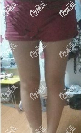 我在呼和浩特張高貴整形大腿環(huán)吸后的個(gè)人經(jīng)歷:術(shù)前也擔(dān)心過吸脂后2個(gè)月腿又粗回去了這個(gè)問題