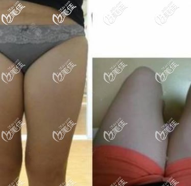 呼和浩特張高貴醫(yī)療美容門診部張高貴術(shù)前照片1