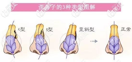歪鼻的幾種程度 歪鼻的幾種程度