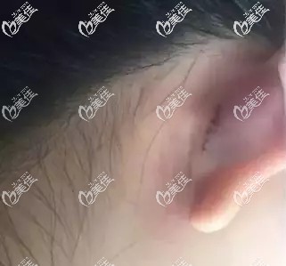 一周拆線后耳后的疤痕