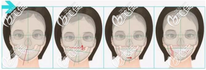 下頜骨正畸術(shù)原理 下頜骨正畸術(shù)原理