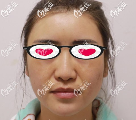 呼和浩特張高貴醫(yī)療美容門診部張高貴術(shù)前照片1