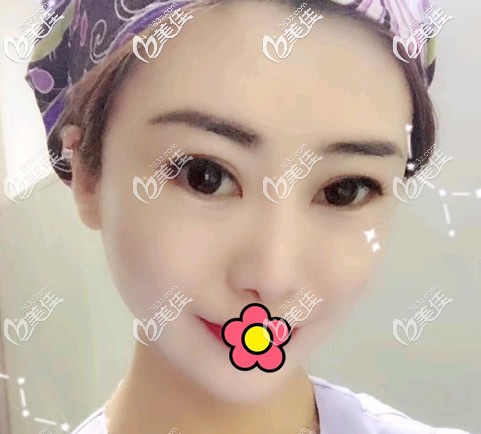 鼻頭扁平?jīng)]鼻尖能長出來?別傻了!還是去做個(gè)自體肋軟骨隆鼻更靠譜一些!