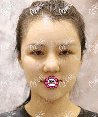 我在北京加減美做肋軟骨隆鼻修復(fù)第8天