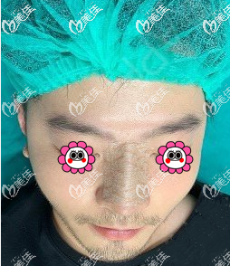 硅膠假體隆鼻術后樣子