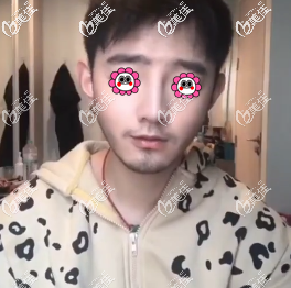 這是我做硅膠假體隆鼻不止7天的恢復(fù)過程圖,做完近兩年也沒出現(xiàn)穿破鼻尖的現(xiàn)象