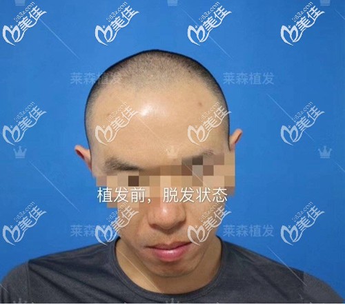 植發(fā)前前額頭頂頭發(fā)稀疏 植發(fā)前前額頭頂頭發(fā)稀疏