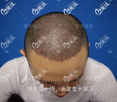 植發(fā)際線一周效果圖 植發(fā)際線一周效果圖