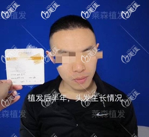 植發(fā)后半年頭發(fā)生長(zhǎng)情況 植發(fā)后半年頭發(fā)生長(zhǎng)情況