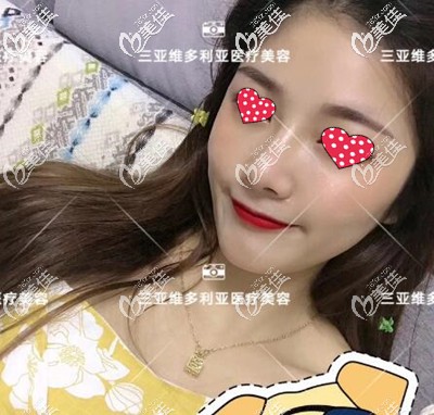 做完鼻整形手術(shù)4個(gè)月了，用本人真實(shí)隆鼻過程及感想告訴你三亞隆鼻整形哪個(gè)醫(yī)院好！