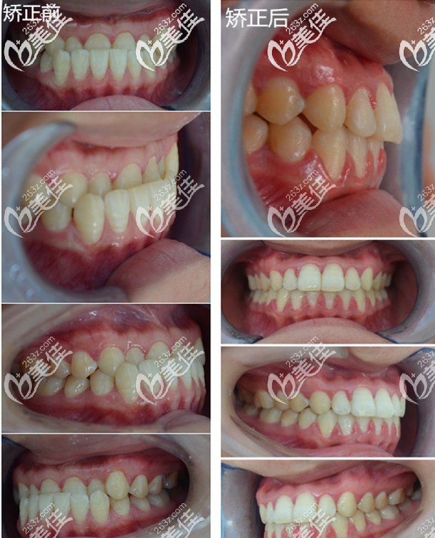 亮出骨性地包天戴牙套對(duì)比照，沒想到隱適美隱形矯正的感覺這么爽！