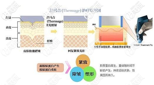 熱瑪吉的治療原理