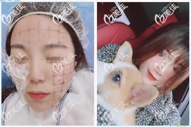 還在糾結(jié)第4代熱瑪吉600、900區(qū)別在哪?聰明姑娘聽醫(yī)生建議已經(jīng)做眼部+全面部抗衰了