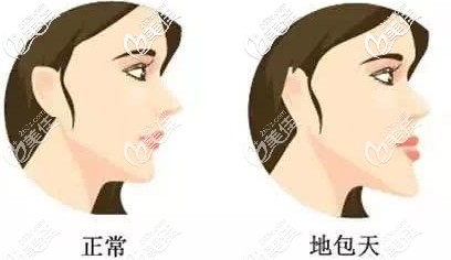 地包天和正常的臉型區(qū)別圖