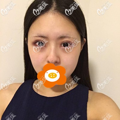 做完雙眼皮第7天還有點(diǎn)腫