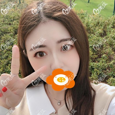 割雙眼皮1個(gè)月