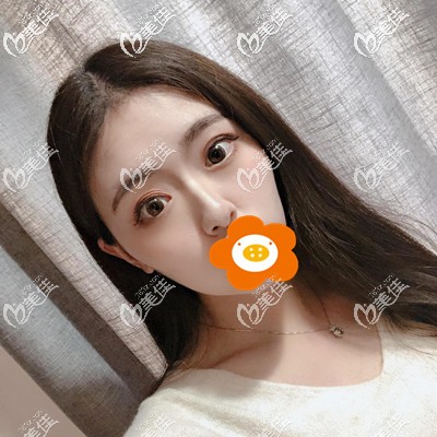 我做了切開(kāi)雙眼皮+開(kāi)眼角，大家看下我的大長(zhǎng)臉適合割開(kāi)扇形狀的雙眼皮嗎？