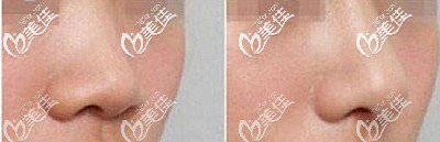 膨體隆鼻后的效果對比 膨體隆鼻后的效果對比